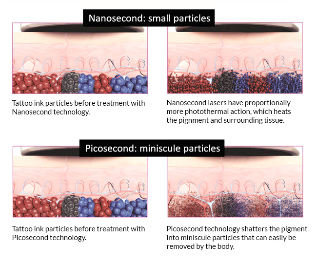 laser pikosekundowy - działanie, usuwanie tatuaży