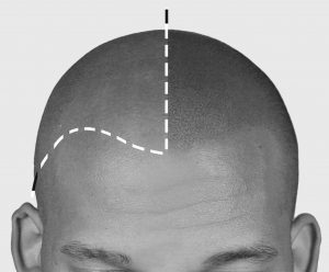 pigmentacja skóry głowy - mikropigmentacja skalpu przed i po