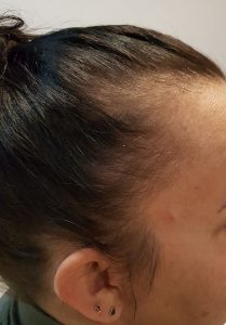 Pigmentacja skóry głowy w zagęszczaniu włosów - przed zabiegiem